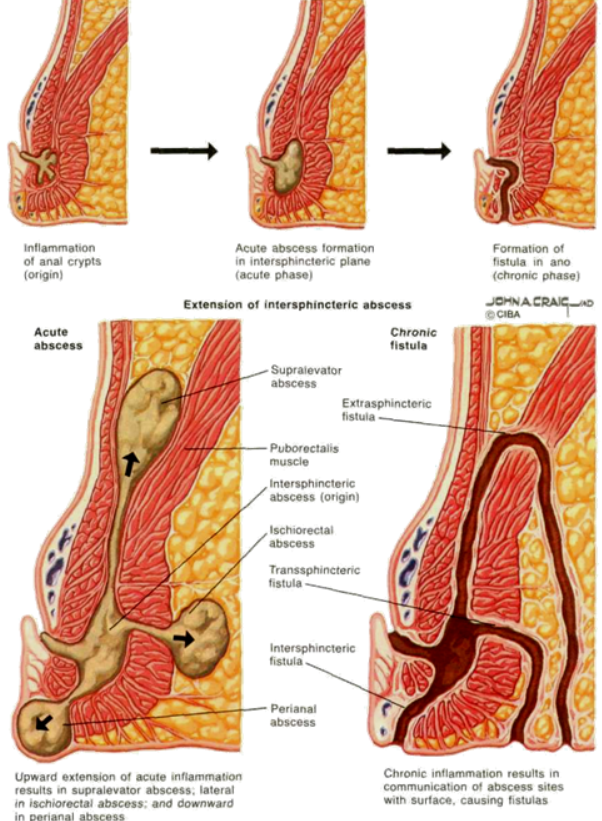 fistula with tuberculosis Anal